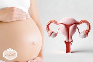 تاثیر زعفران بر کیست تخمدان